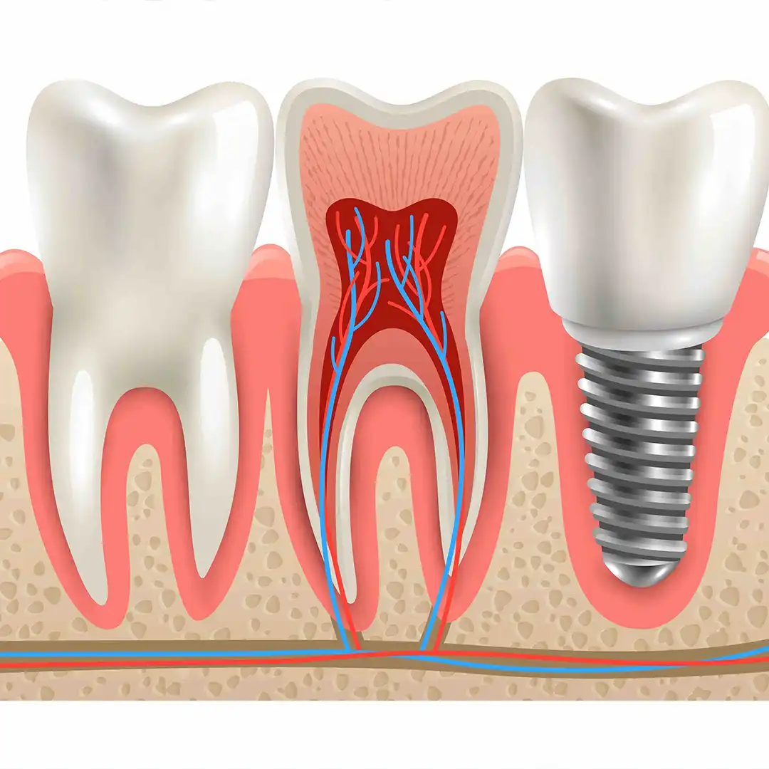 Implantes Dentales